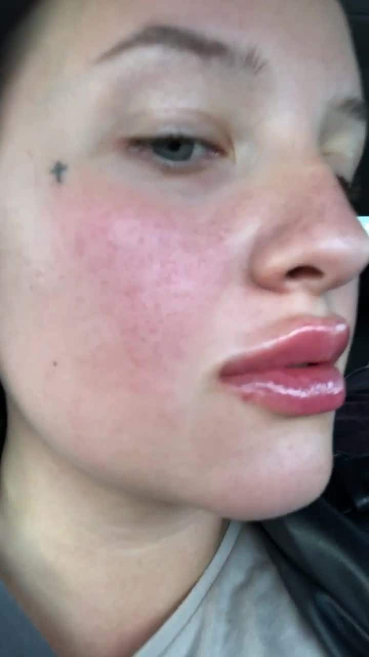 Linnéa, 23: ”Jag blev blind, jag ville ha mer”