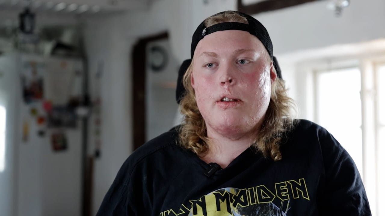 Viktor, 16,  vaknade upp utan armar och ben: "Ska bli första amputerade svetsaren"