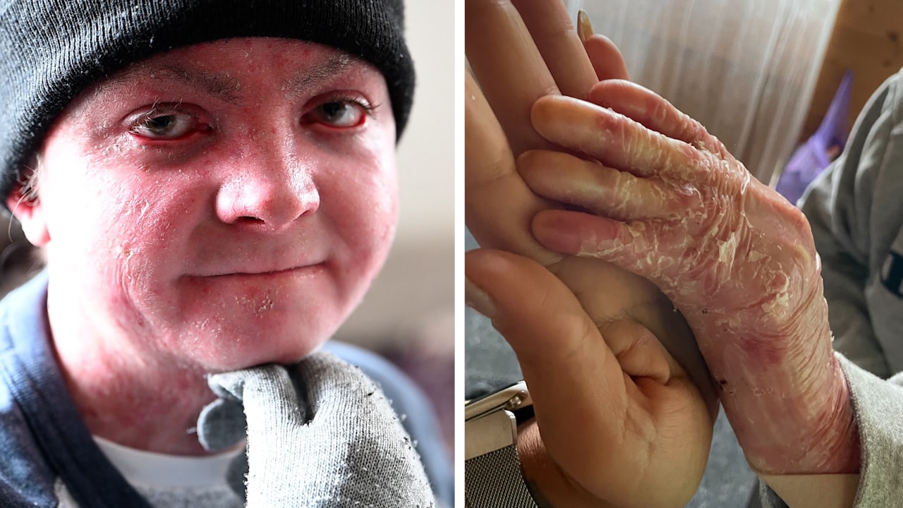 Mike Olsson, 20, har fjärilssjukan: “Tappar huden”