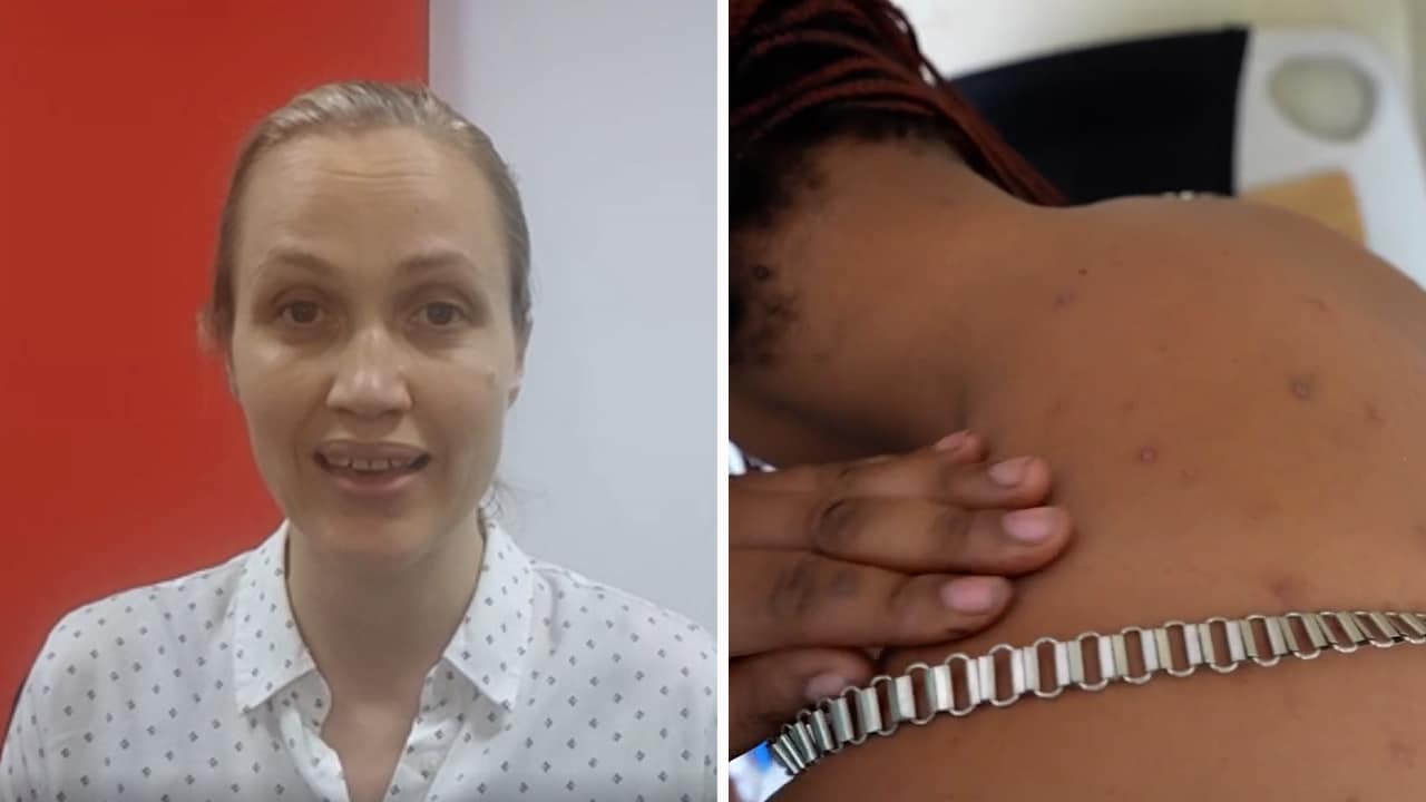 Rädda Barnen: Därför drabbas flest barn av Mpox