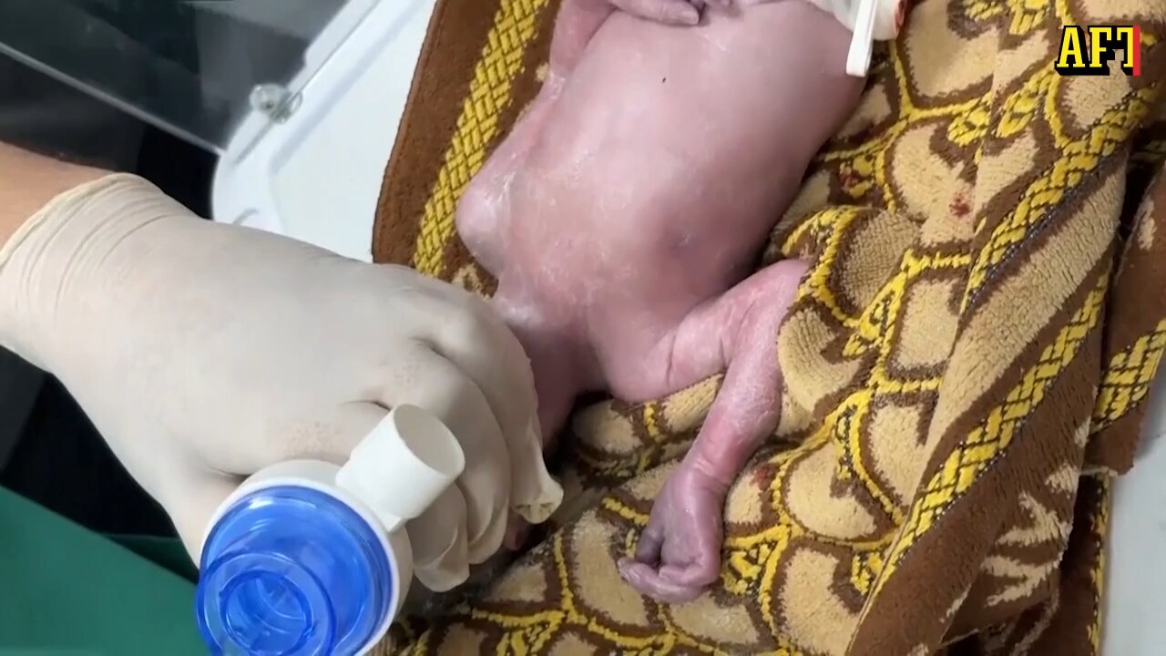 Här räddas babyn ur sin döende mammas mage • Varning för starka bilder